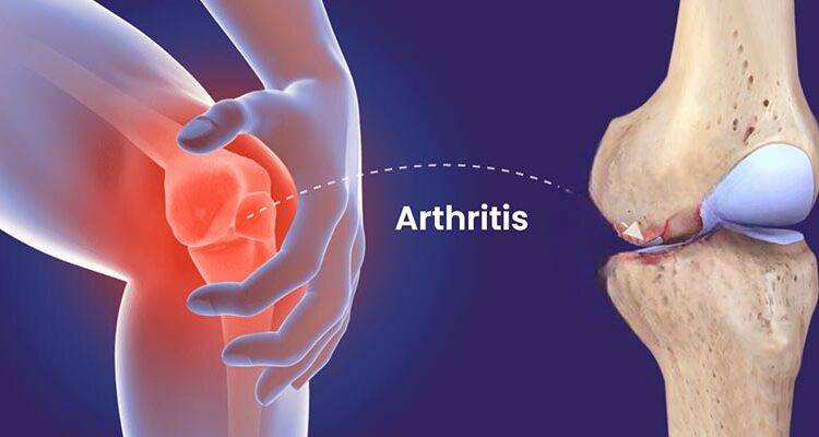 Arthritis